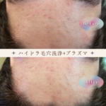 ジュニアニキビケア_水光ピールスキン
